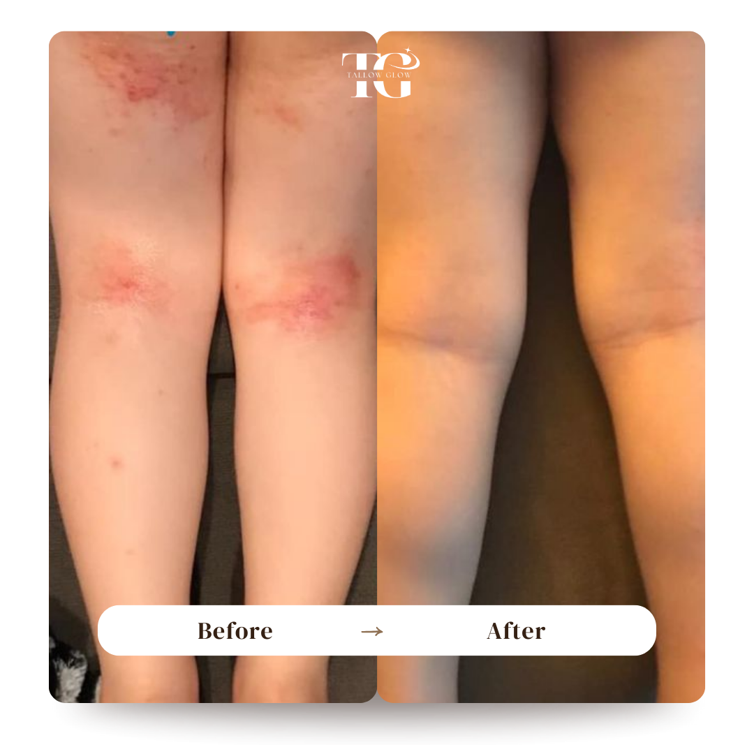 Waarom Tallow Zo Goed Helpt Bij Eczeem